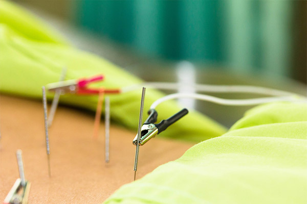 Acupunctuur Zaandam - Acupunctuur Koog aan de Zaan - Acupunctuur Zaanstad | Behandelingen Acupunctuur Wang: Elektro-acupunctuur